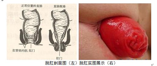 脱肛是怎么引起的