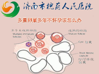 多囊卵巢