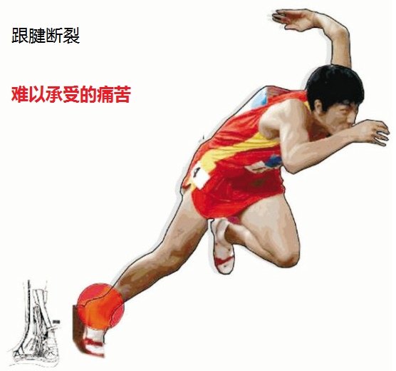 跟腱断了还能好吗