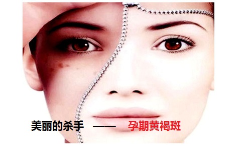 孕期黄褐斑，你出现了吗