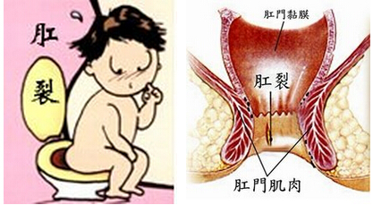 肛裂预防方法有哪些