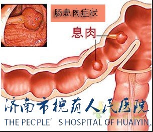肠息肉术后相关事项有哪些