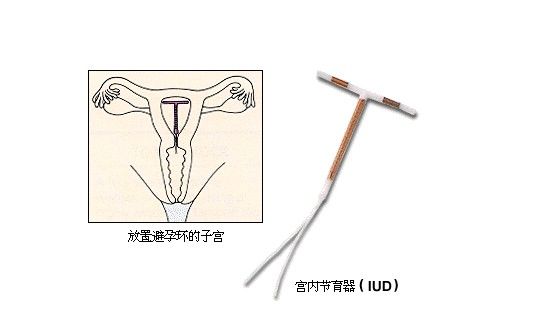 关于带环女性需了解哪些相关事项