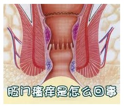如何解决肛周瘙痒的难题
