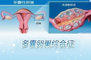 患上多囊卵巢有哪些症状表现