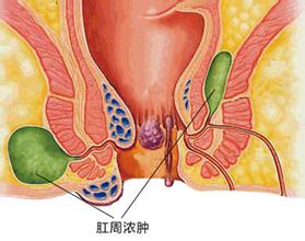 肛周脓肿导致发热后该怎么办
