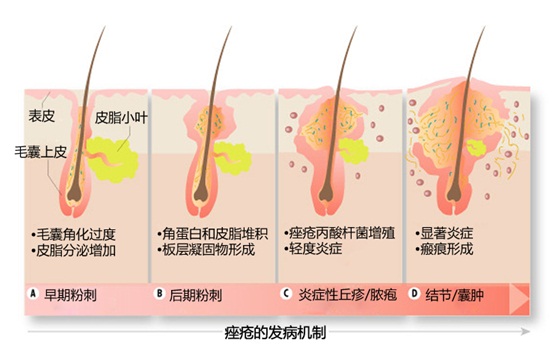 痤疮是怎么引起的