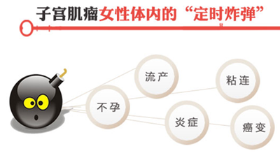 子宫肌瘤