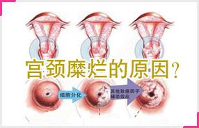 宫颈糜烂为何老治不好
