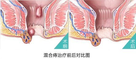 女性混合痔危害