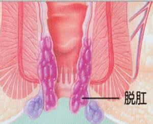 脱肛要素有什么
