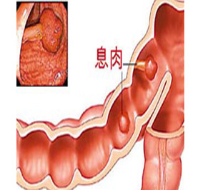 结肠息肉发病的病因