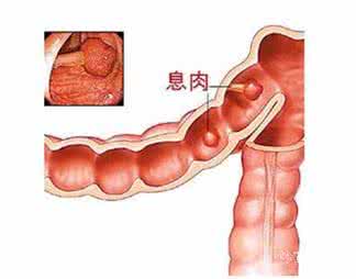 肠息肉原因是什么
