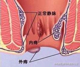 女性痔疮治疗方法
