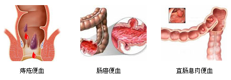 无痛便血