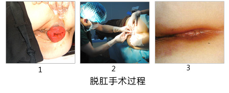 脱肛手术过程