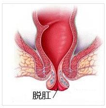 什么是脱肛