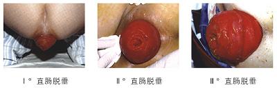 脱肛的主要症状
