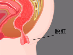 导致脱肛的原因有哪些