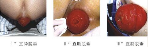 脱肛