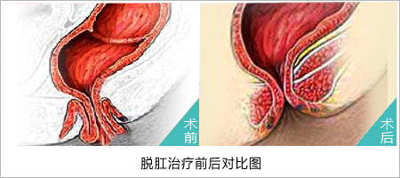 脱肛治疗前后对比