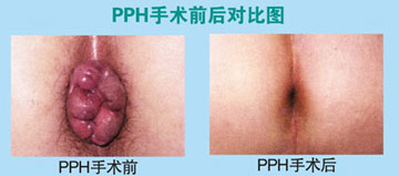 脱肛治疗前后对比