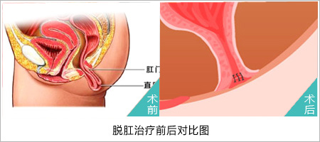 脱肛的最佳治疗方法