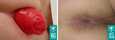 脱肛治疗前后对比